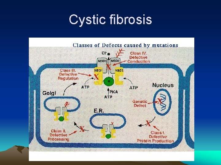 Cystic fibrosis 