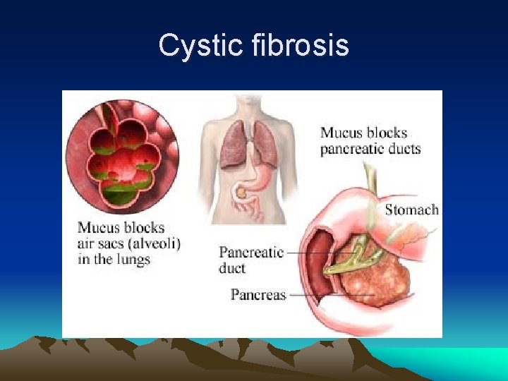 Cystic fibrosis 