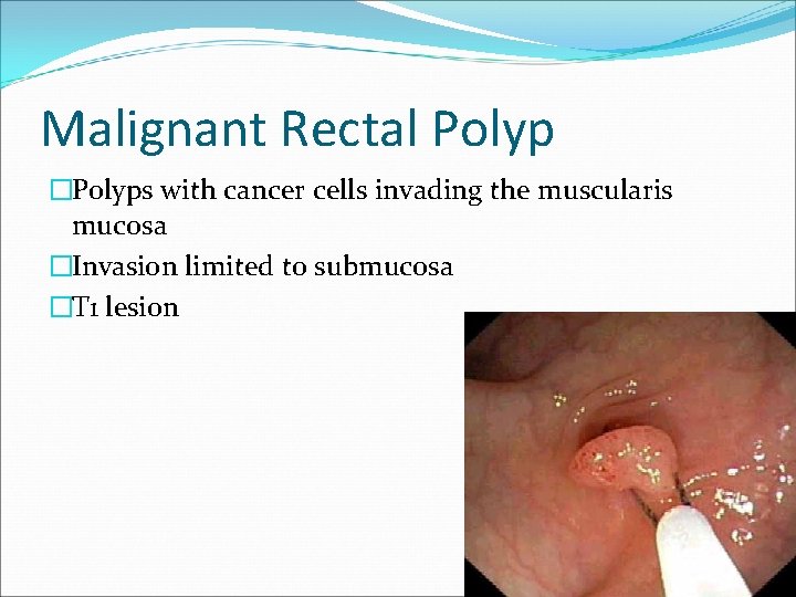 Malignant Rectal Polyp �Polyps with cancer cells invading the muscularis mucosa �Invasion limited to