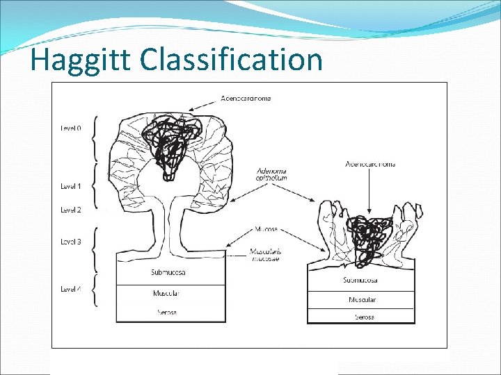 Haggitt Classification 