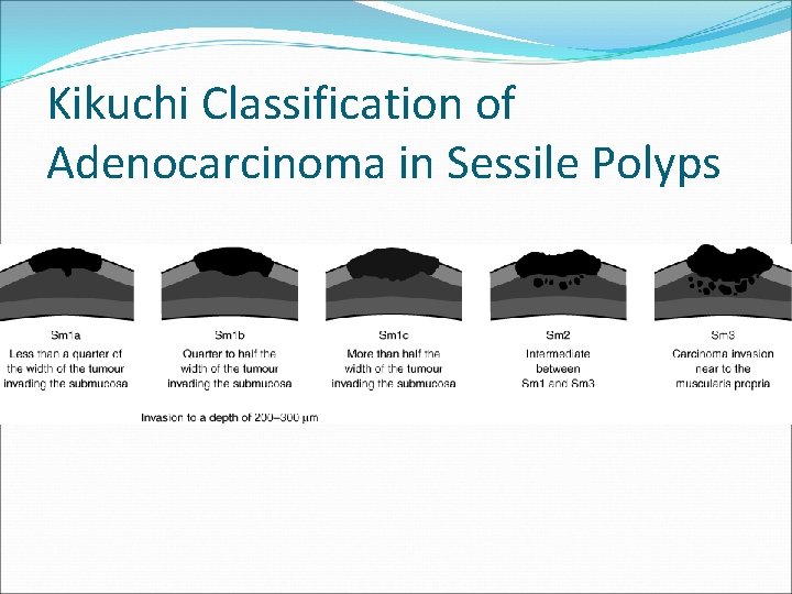 Kikuchi Classification of Adenocarcinoma in Sessile Polyps 