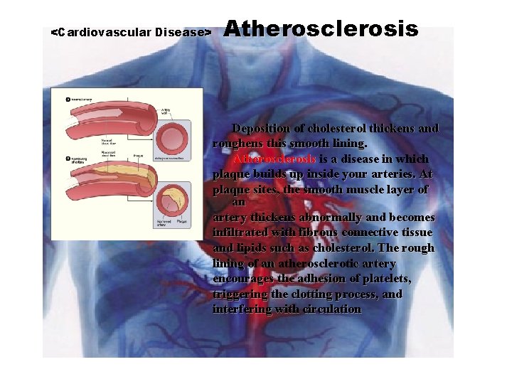 <Cardiovascular Disease> Atherosclerosis Deposition of cholesterol thickens and roughens this smooth lining. Atherosclerosis is