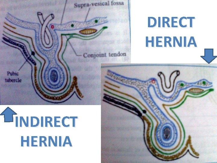 DIRECT HERNIA INDIRECT HERNIA 