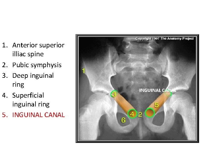 1. Anterior superior illiac spine 2. Pubic symphysis 3. Deep inguinal ring 4. Superficial