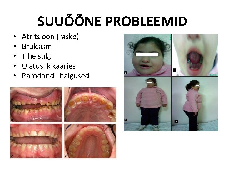 SUUÕÕNE PROBLEEMID • • • Atritsioon (raske) Bruksism Tihe sülg Ulatuslik kaaries Parodondi haigused