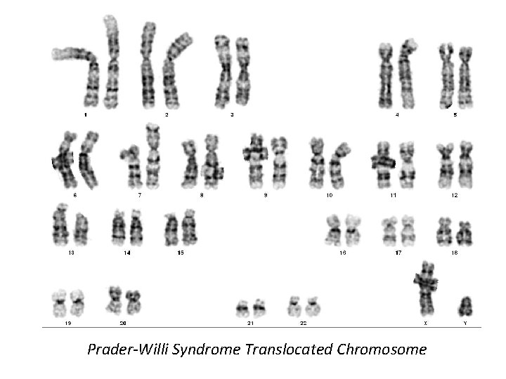 Prader-Willi Syndrome Translocated Chromosome 