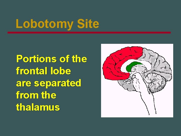 Lobotomy Site Portions of the frontal lobe are separated from the thalamus 