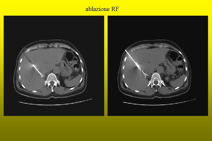 ablazione RF 