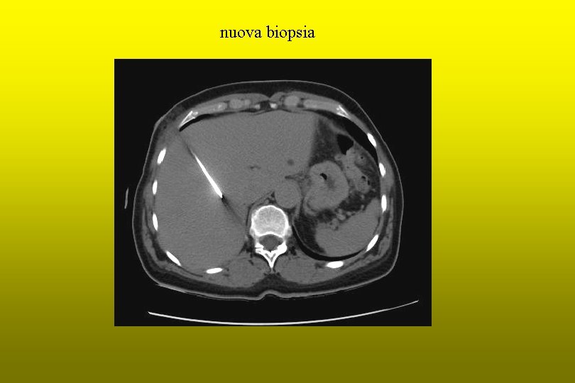 nuova biopsia 