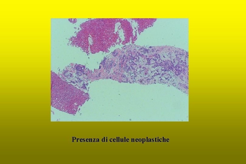 Presenza di cellule neoplastiche 