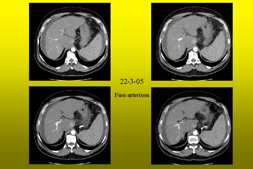 22 -3 -05 Fase arteriosa 