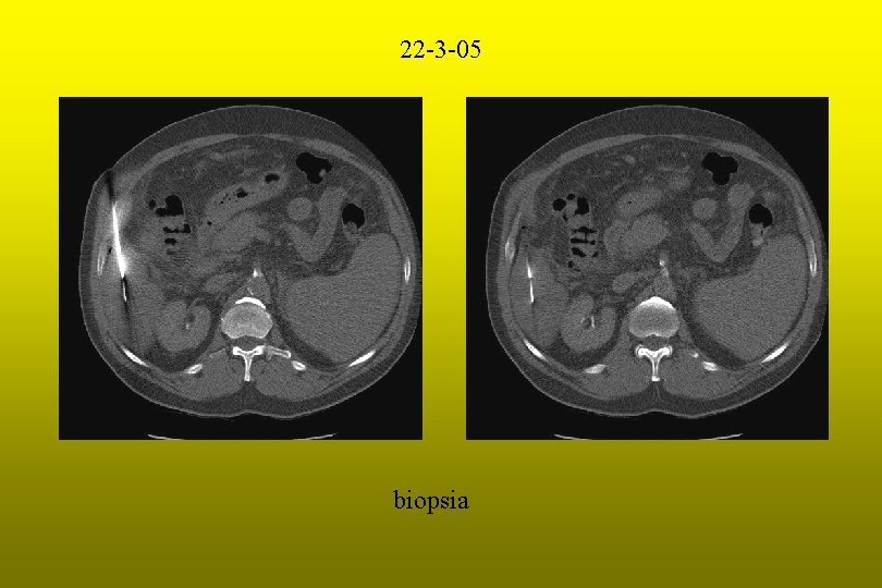 22 -3 -05 biopsia 