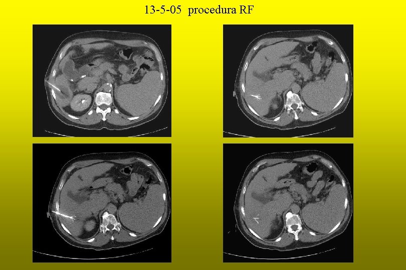 13 -5 -05 procedura RF 
