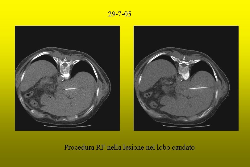 29 -7 -05 Procedura RF nella lesione nel lobo caudato 