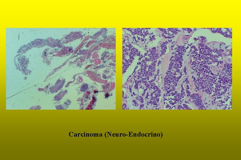 Carcinoma (Neuro-Endocrino) 