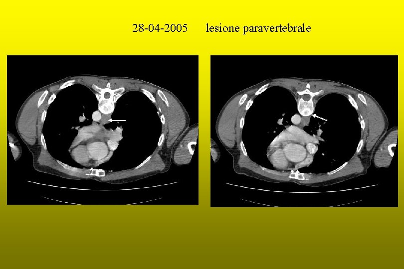 28 -04 -2005 lesione paravertebrale 