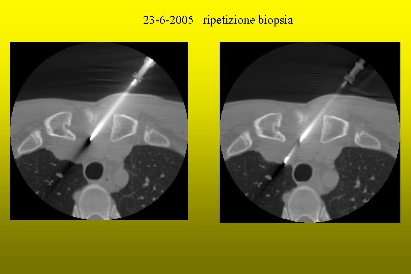 23 -6 -2005 ripetizione biopsia 