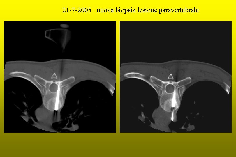 21 -7 -2005 nuova biopsia lesione paravertebrale 