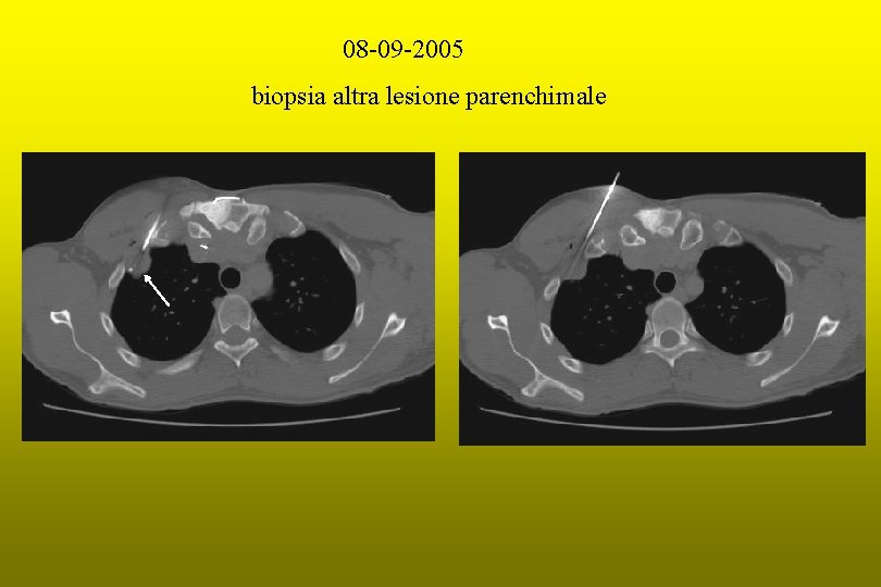 08 -09 -2005 biopsia altra lesione parenchimale 