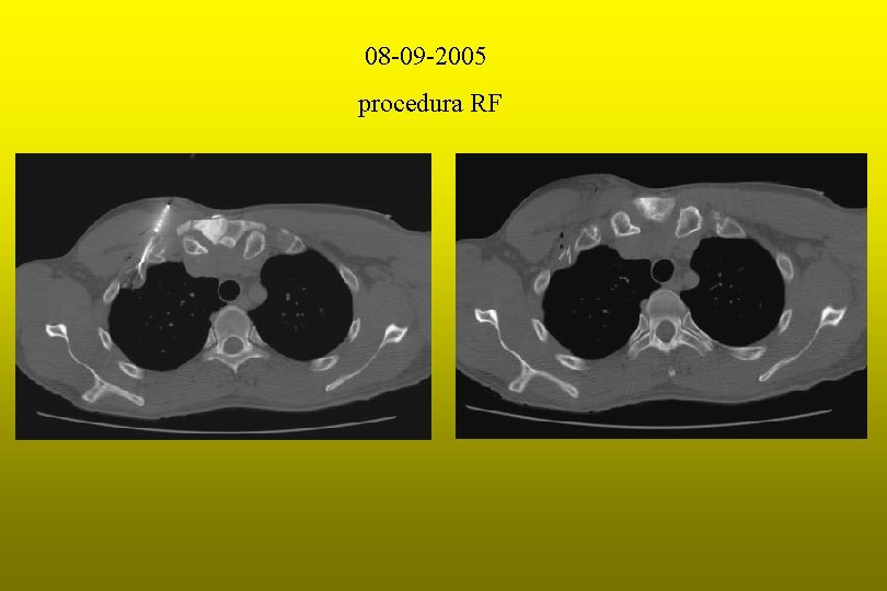 08 -09 -2005 procedura RF 