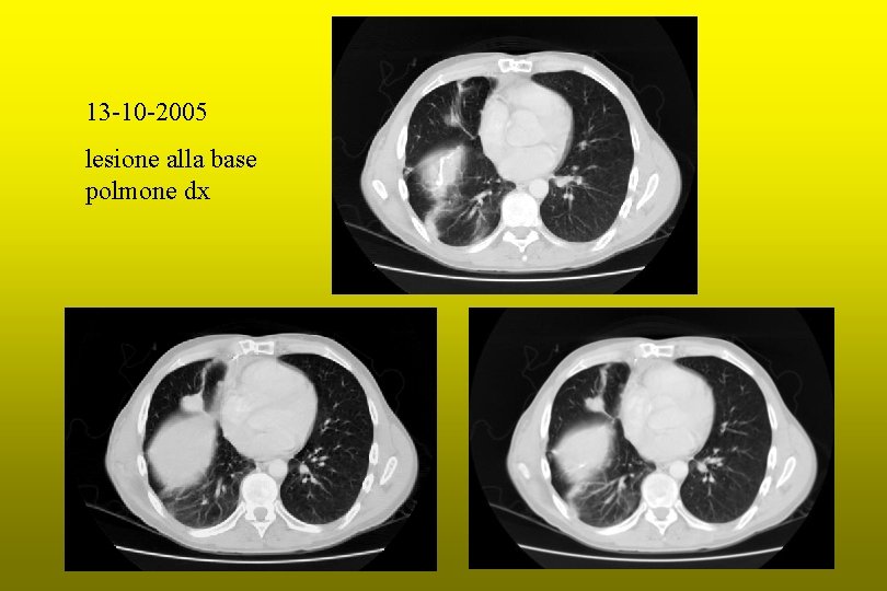 13 -10 -2005 lesione alla base polmone dx 