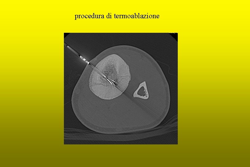 procedura di termoablazione 