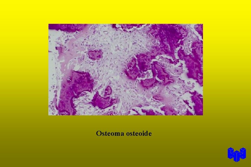 Osteoma osteoide 