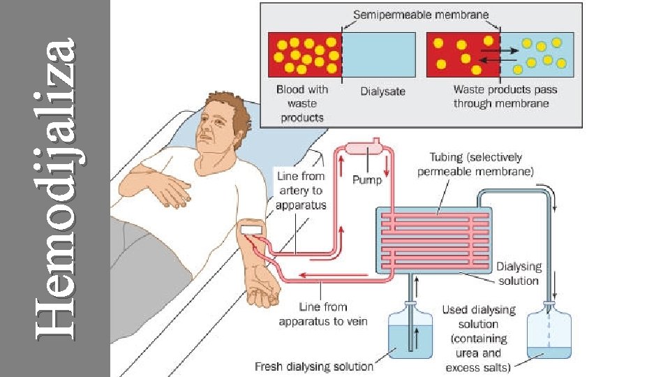 Hemodijaliza 