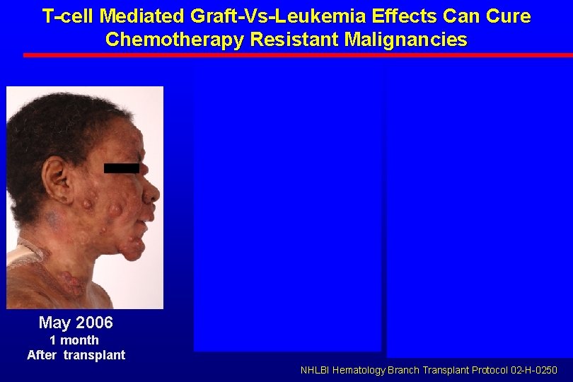 T-cell Mediated Graft-Vs-Leukemia Effects Can Cure Chemotherapy Resistant Malignancies May 2006 1 month After