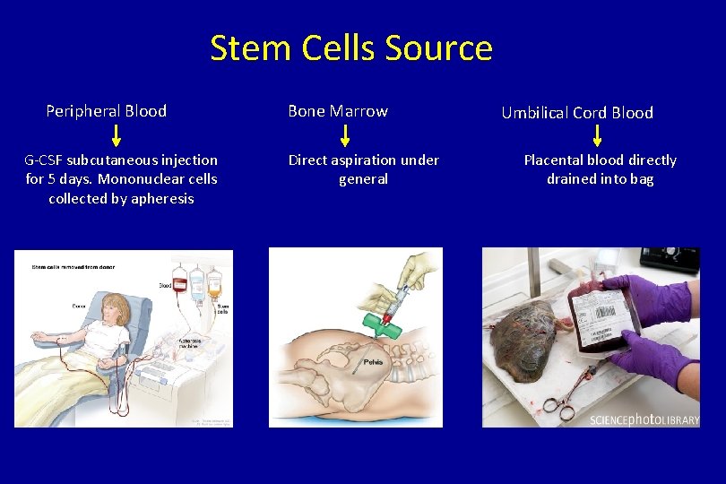 Stem Cells Source Peripheral Blood G-CSF subcutaneous injection for 5 days. Mononuclear cells collected