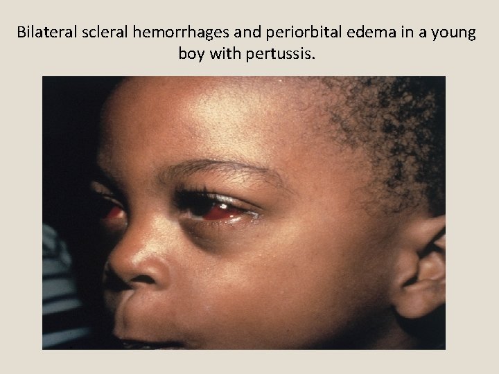 Bilateral scleral hemorrhages and periorbital edema in a young boy with pertussis. 