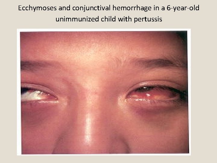 Ecchymoses and conjunctival hemorrhage in a 6 -year-old unimmunized child with pertussis 