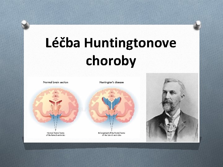 Léčba Huntingtonove choroby 