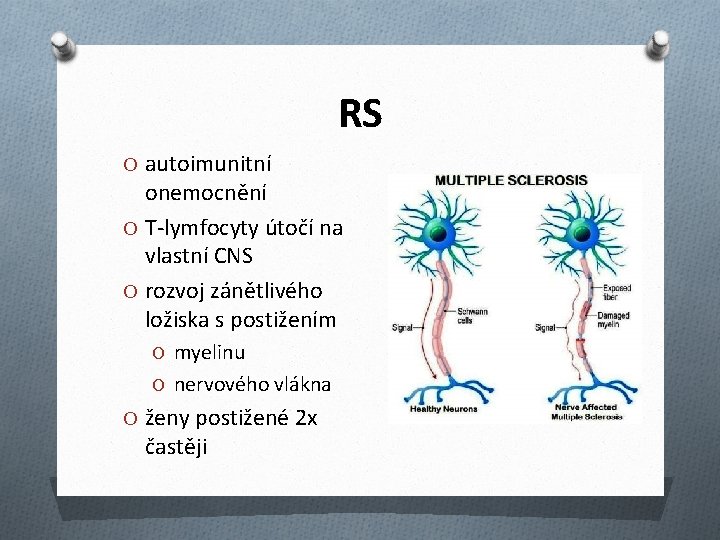 RS O autoimunitní onemocnění O T-lymfocyty útočí na vlastní CNS O rozvoj zánětlivého ložiska