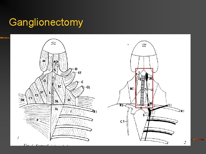 Ganglionectomy 
