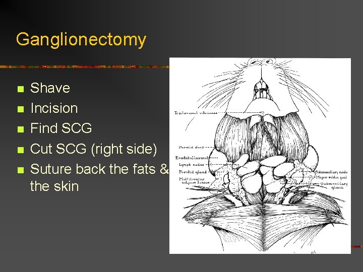 Ganglionectomy n n n Shave Incision Find SCG Cut SCG (right side) Suture back