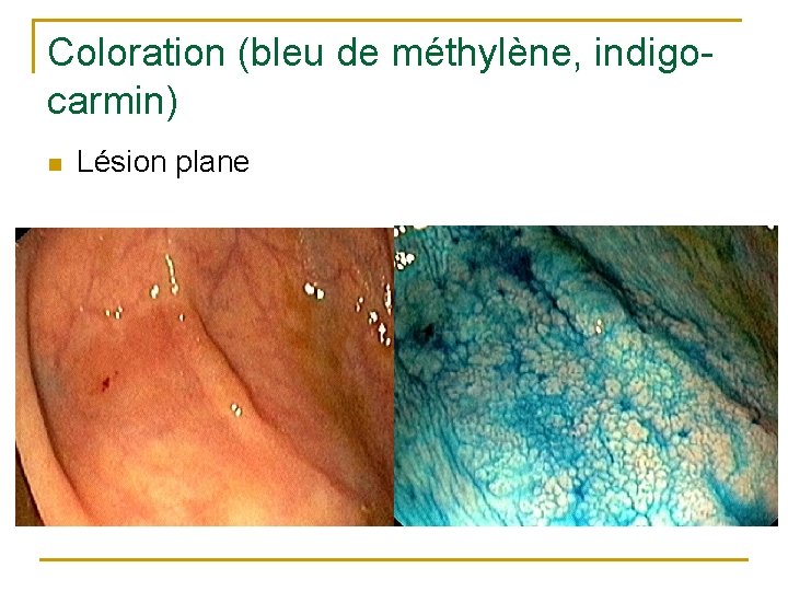 Coloration (bleu de méthylène, indigocarmin) n Lésion plane 