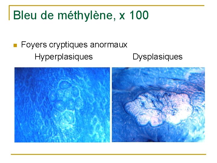Bleu de méthylène, x 100 n Foyers cryptiques anormaux Hyperplasiques Dysplasiques 