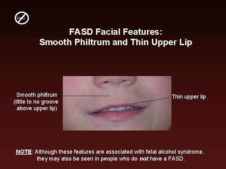 FASD Facial Features: Smooth Philtrum and Thin Upper Lip Smooth philtrum (little to no