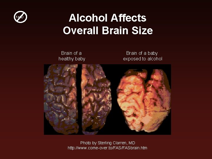 FASD Alcohol Affects Overall Brain Size Brain of a healthy baby Brain of a