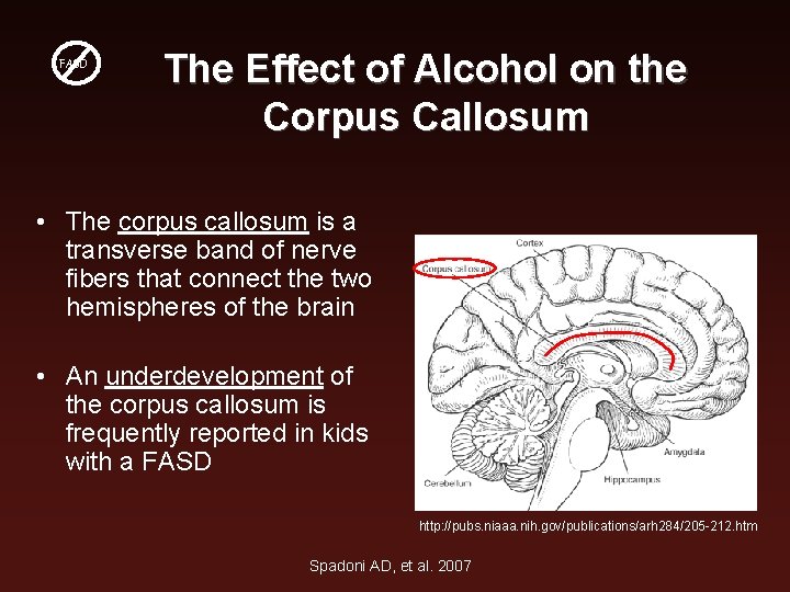 FASD The Effect of Alcohol on the Corpus Callosum • The corpus callosum is