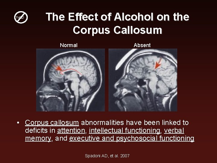 FASD The Effect of Alcohol on the Corpus Callosum Normal Absent • Corpus callosum