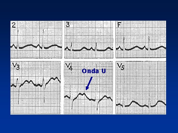 Onda U 