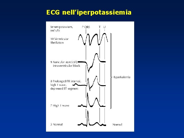 ECG nell’iperpotassiemia 