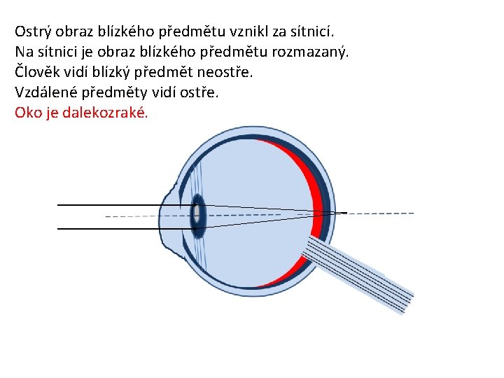 Ostrý obraz blízkého předmětu vznikl za sítnicí. Na sítnici je obraz blízkého předmětu rozmazaný.