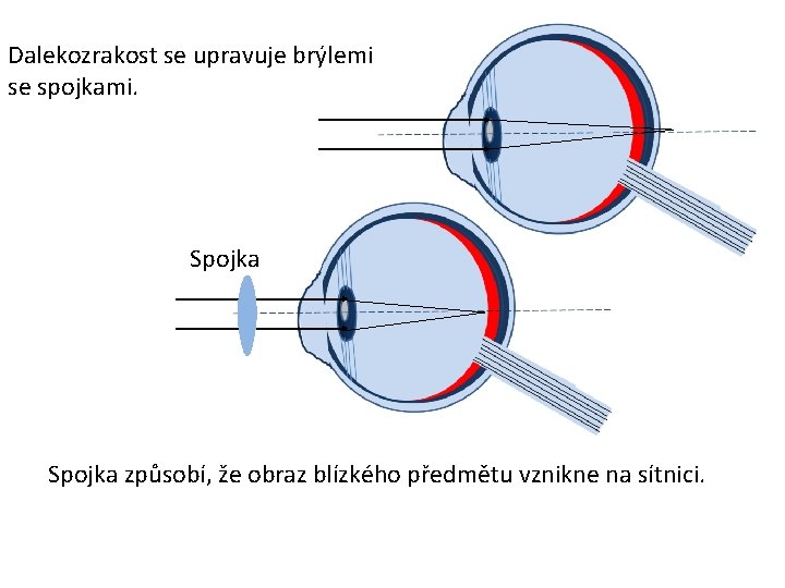 Dalekozrakost se upravuje brýlemi se spojkami. Spojka způsobí, že obraz blízkého předmětu vznikne na