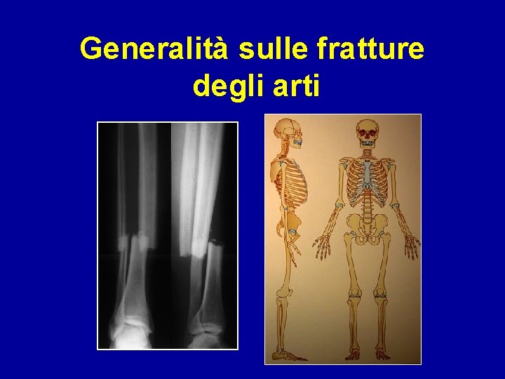 Generalità sulle fratture degli arti 