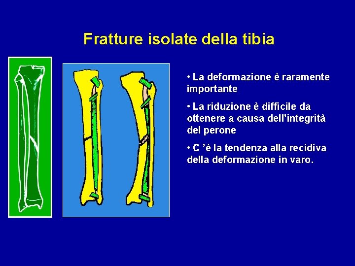 Fratture isolate della tibia • La deformazione è raramente importante • La riduzione è