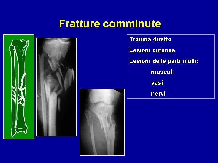 Fratture comminute Trauma diretto Lesioni cutanee Lesioni delle parti molli: muscoli vasi nervi 