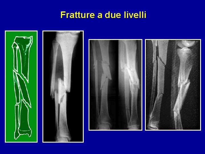 Fratture a due livelli 